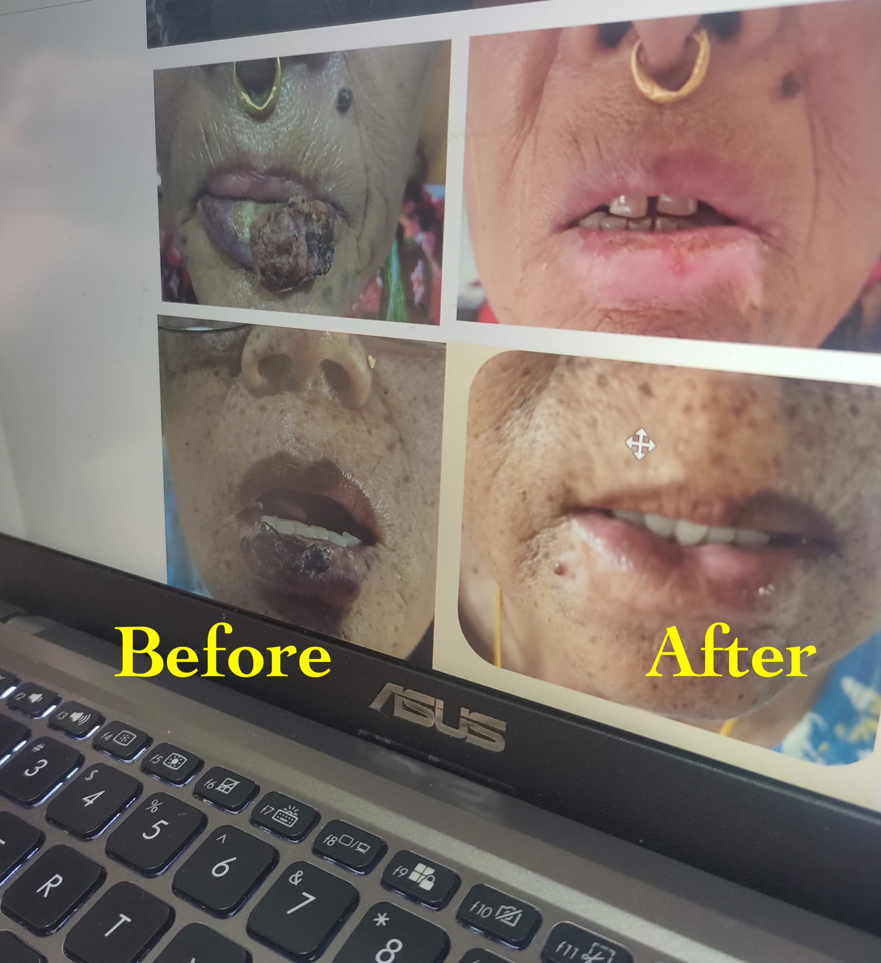 Lips Cancer Brachytherapy Treatments