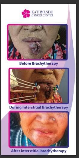 Lips Cancer Brachytherapy Treatment