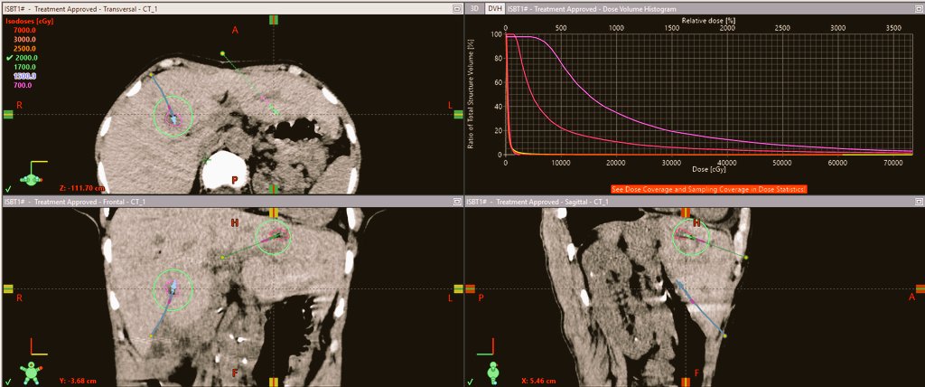 Liver Cancer Brachytherapy Treatment