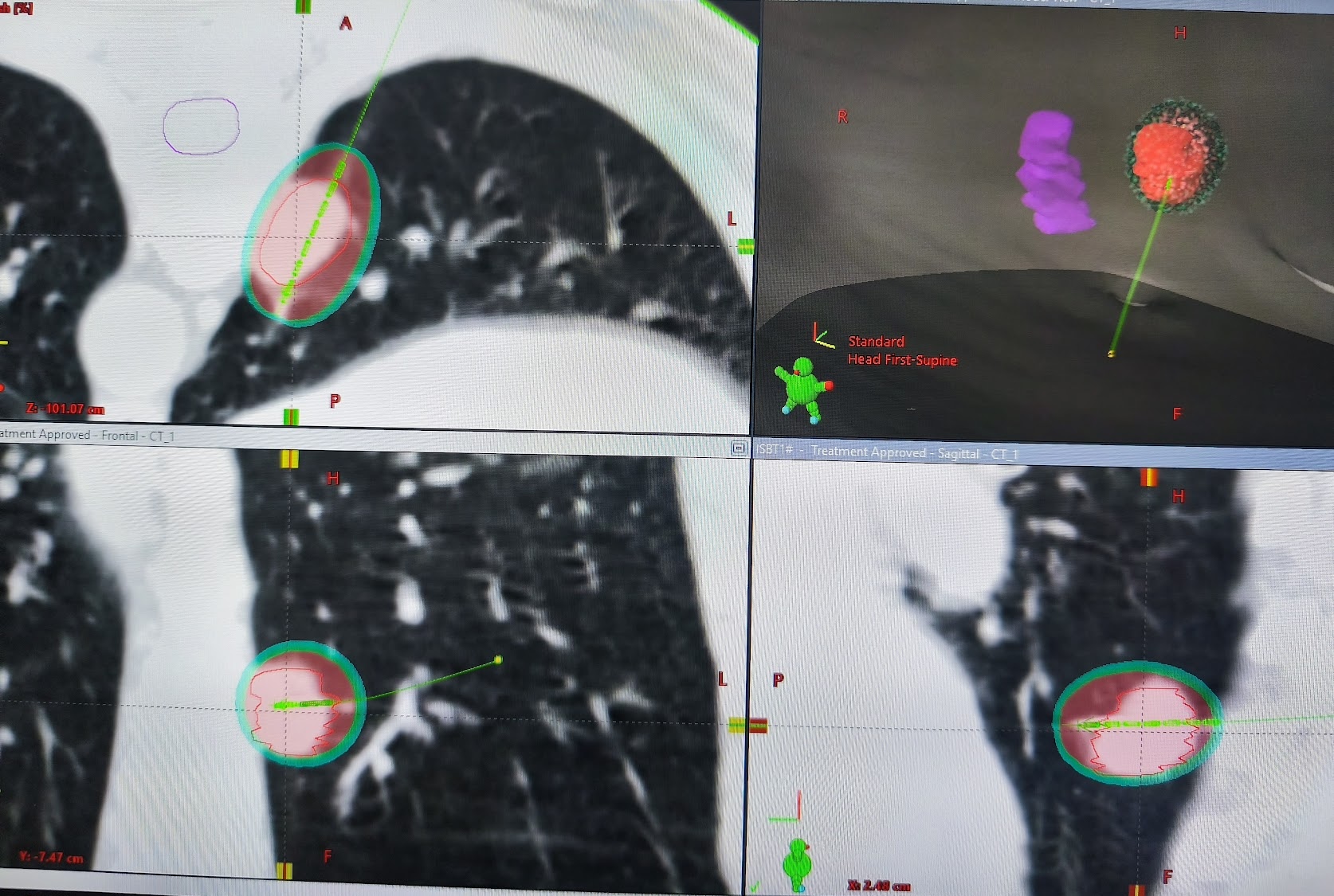 Lung Cancer Brachytherapy Treatment