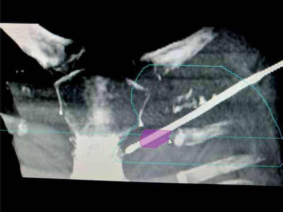 Interstitial brachytherapy for internal mammary node case report