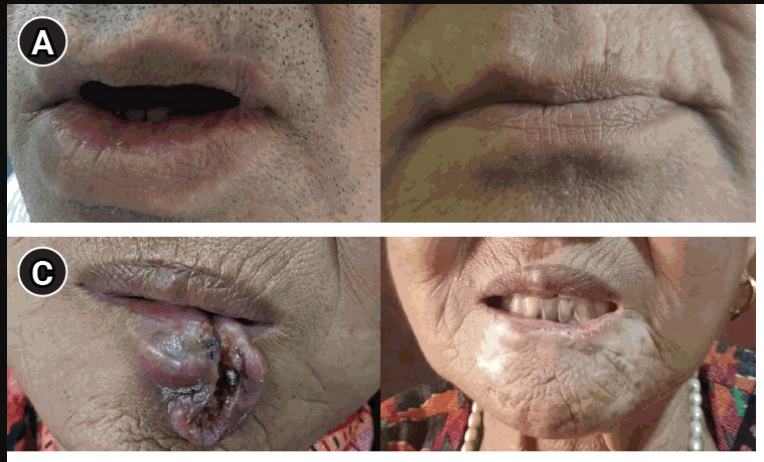 HDR interstitial brachytherapy lip and buccal mucosa study