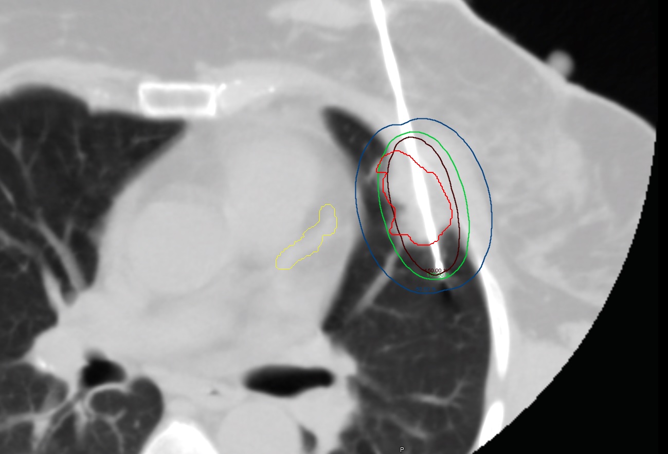CT-guided HDR Interstitial Brachytherapy Study