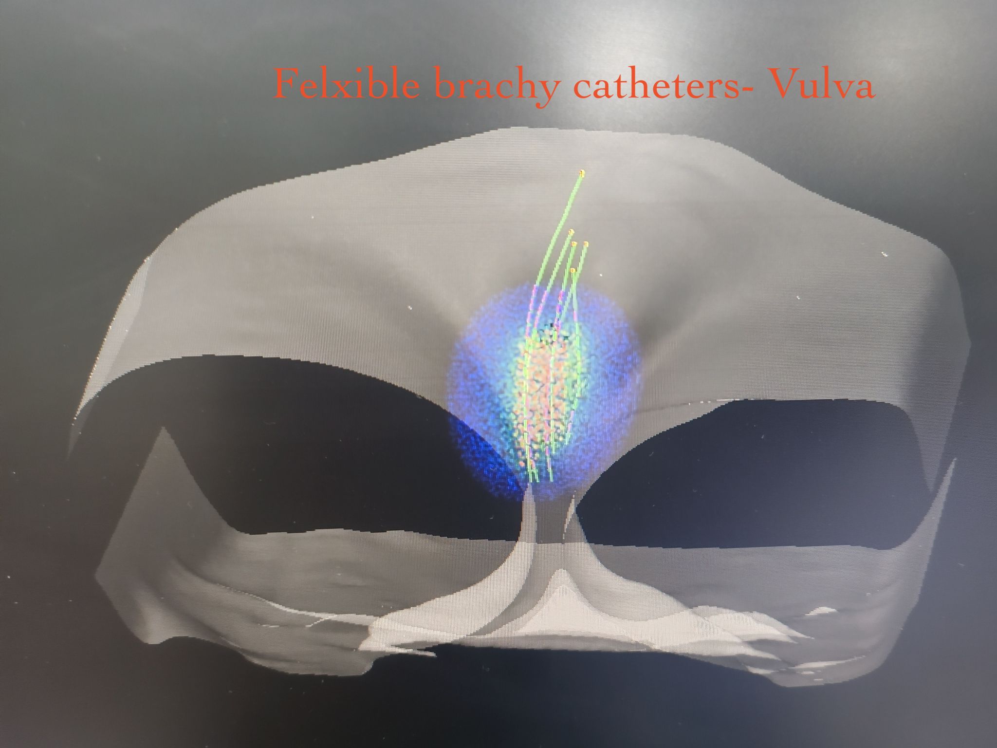 Vulva cancer brachytherapy