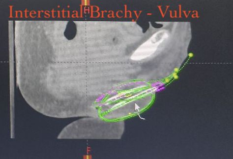 Vulva cancer interstitial