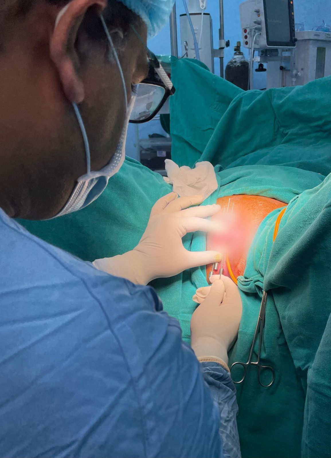 Applicator placement in OT
